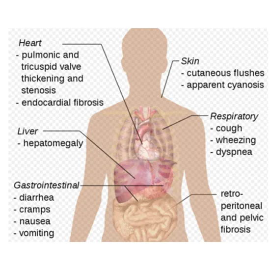 Paraneoplastic Neurologic Syndrome: Types, Causes & Treatment